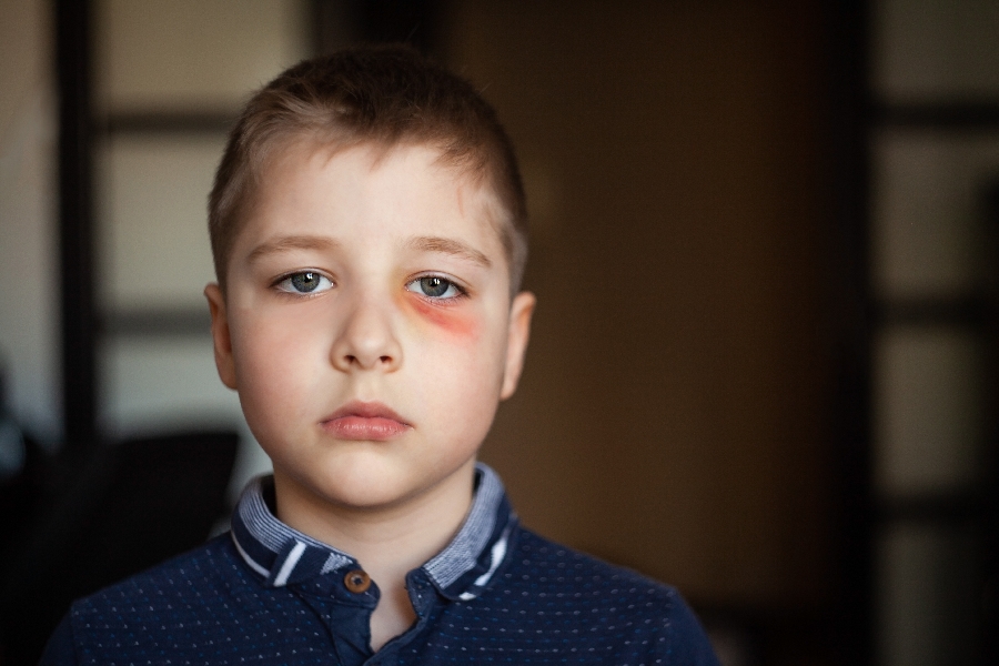 A boy with a black eye